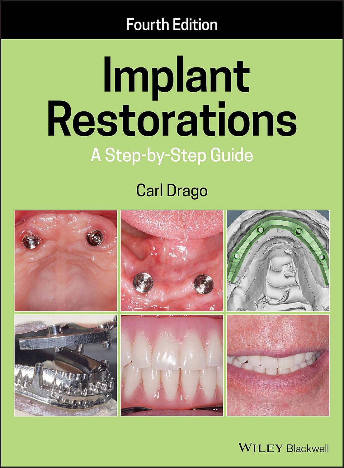 Implant Restorations: A Step–by–Step Guide