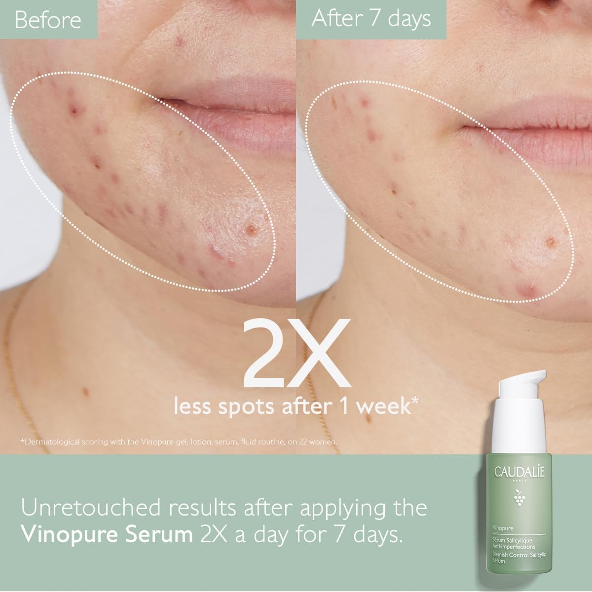 Caudalie Vinopure Blemish Control Salicilic Serum - 30Ml